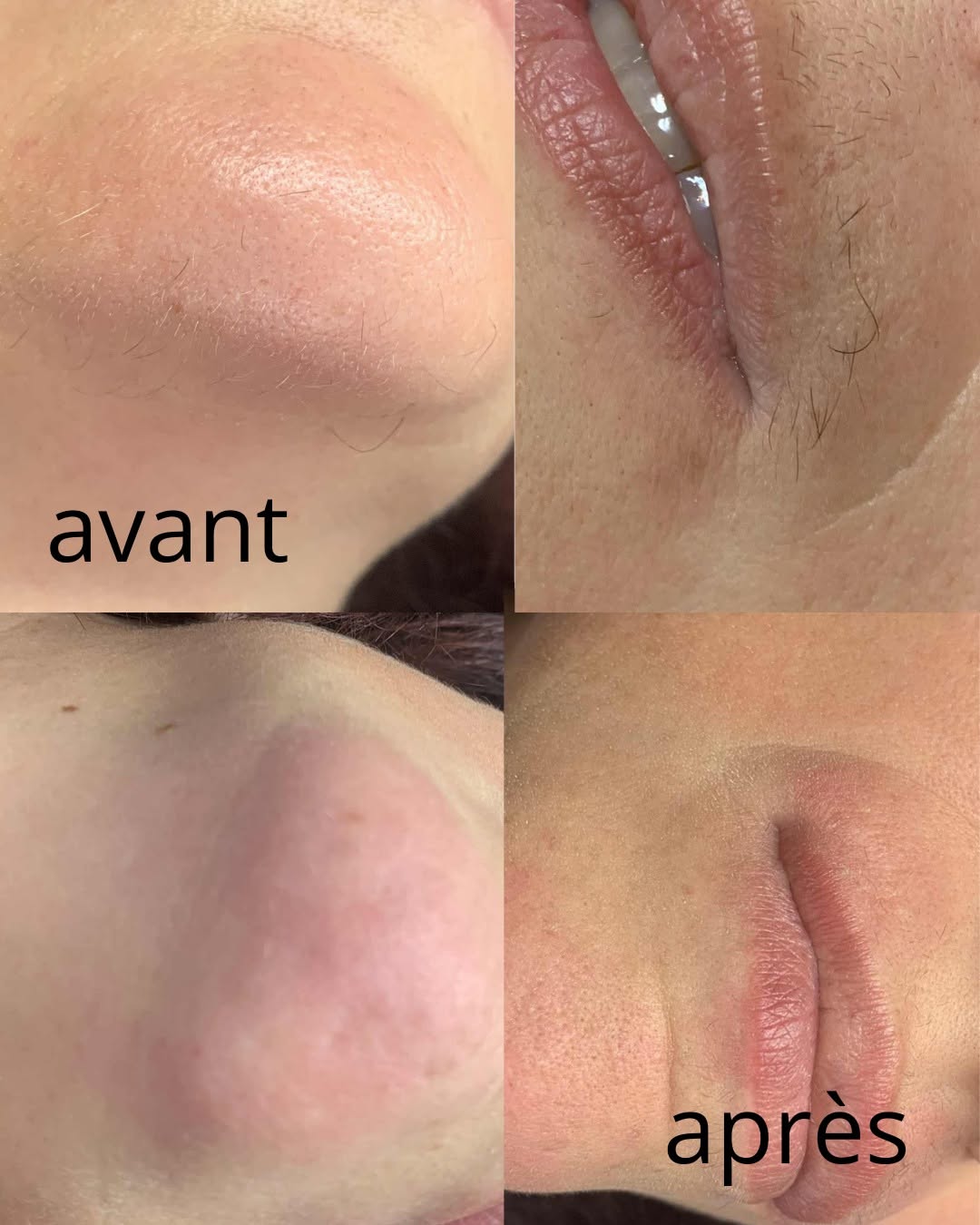 Épilation thermolyse · avant / après